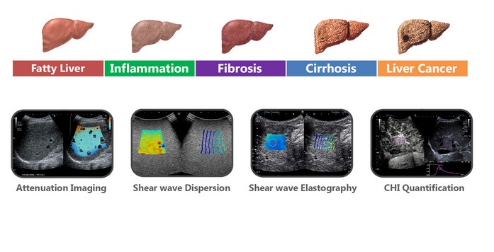 Aplio i series full range of liver imaging wit aplio i series