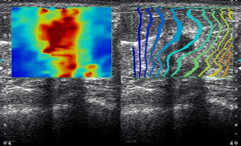 Aplio i series shear wave 1